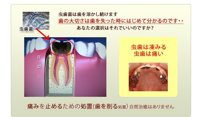 虫歯進行過程2